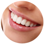 Carillas Dentales en Resina