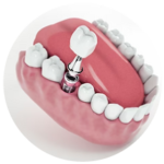 Implantes