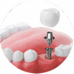 Corona Sobre Implantes